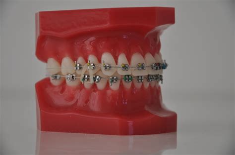 fastbraces reddit